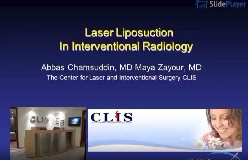 Laser Liposuction in Interventional Radiology