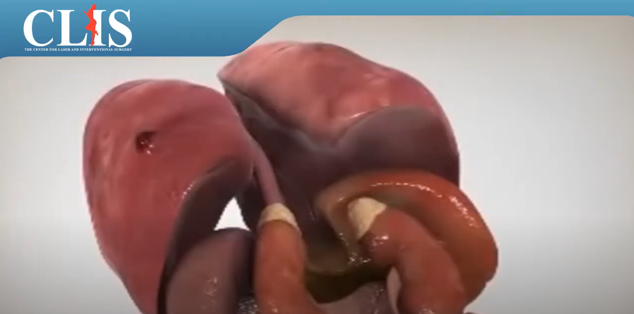 Lung Ablation & Liver Metastases