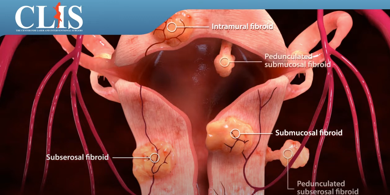 Uterine Fibroid Embolization