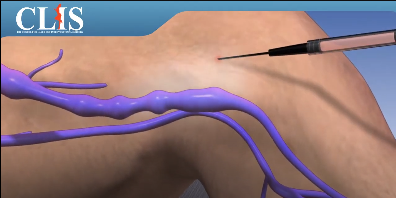 Varicose Veins Ablation